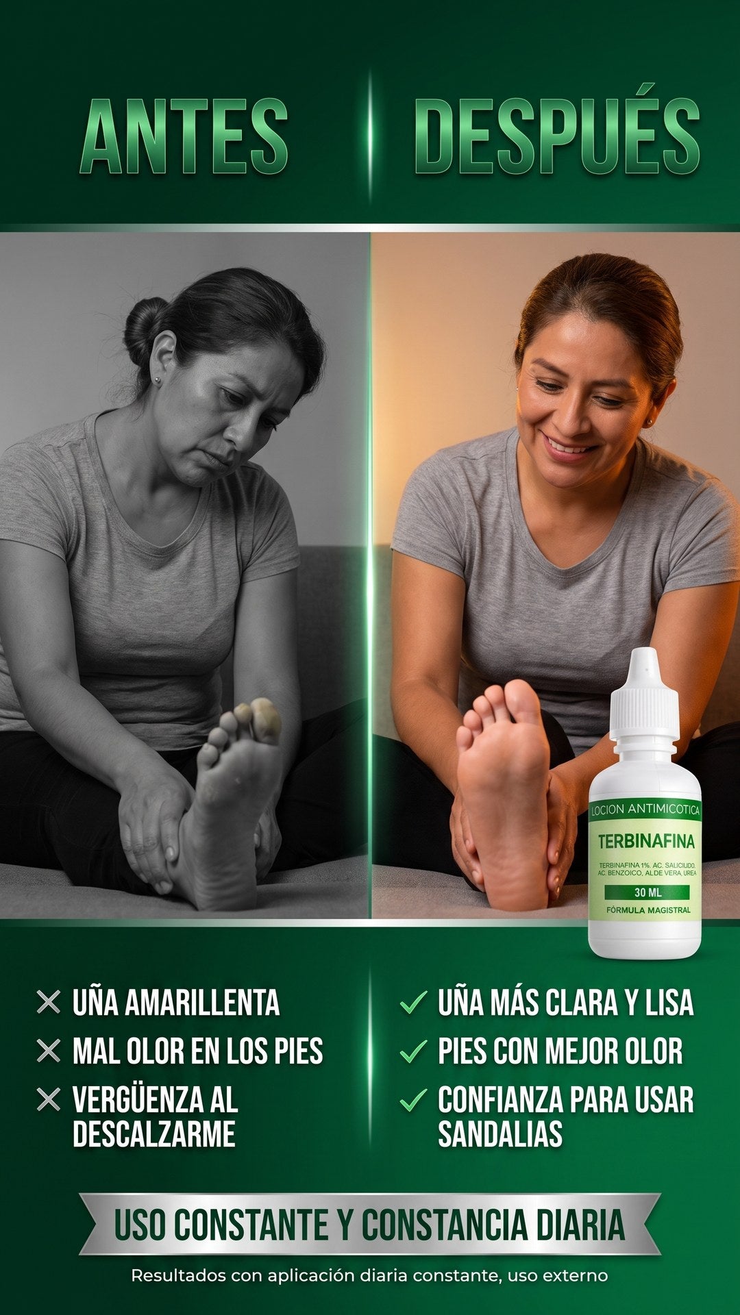 Antes y después de usar la loción antimicótica Terbinafina DermaVital en la uña del pie