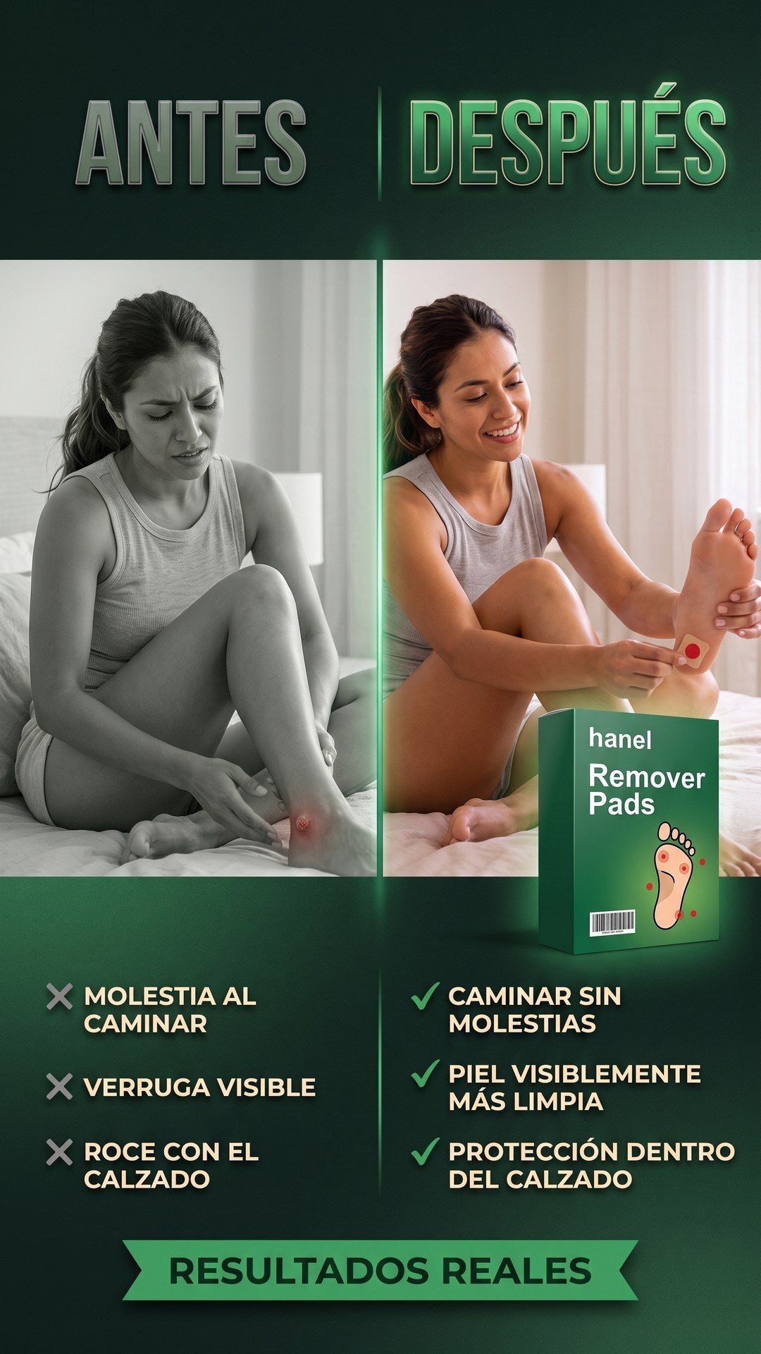 Antes y después de usar los Parches Removedores Hanel para verrugas y callos en el pie